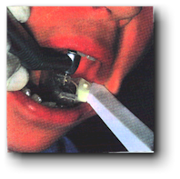 Paquet de 4 canules Clean-Up - rupture de stock – Image 6