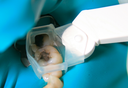 Paquet de 4 canules Clean-Up - rupture de stock – Image 5